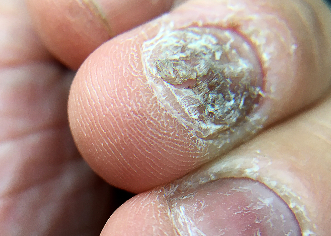 Nail Problems